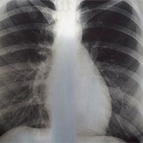 Lunge-Röntgenaufnahme
